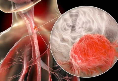 Các dấu hiệu nhận biết sớm ung thư thực quản